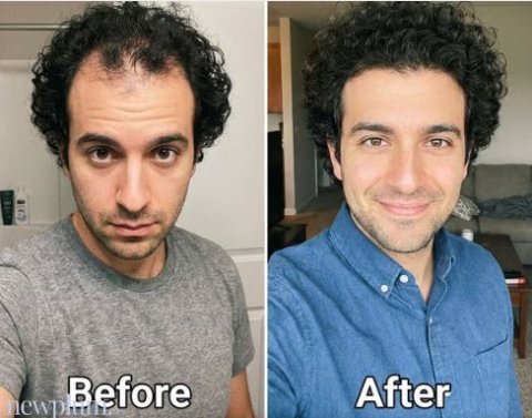Newplum: Advanced Hair Growth Roll-On Serum