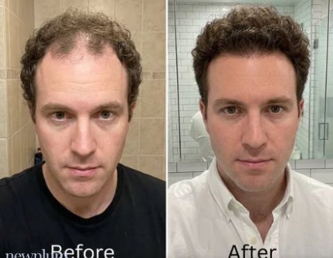 Newplum: Advanced Hair Growth Roll-On Serum