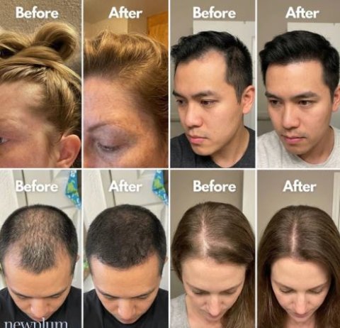 Newplum: Advanced Hair Growth Roll-On Serum