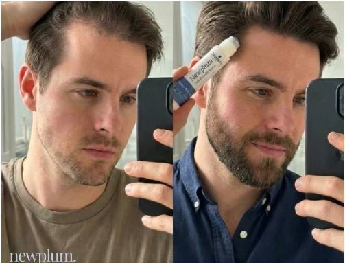 Newplum: Advanced Hair Growth Roll-On Serum