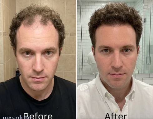 Newplum: Advanced Hair Growth Roll-On Serum